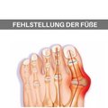 Hallux Valgus - Zehen Spreizer